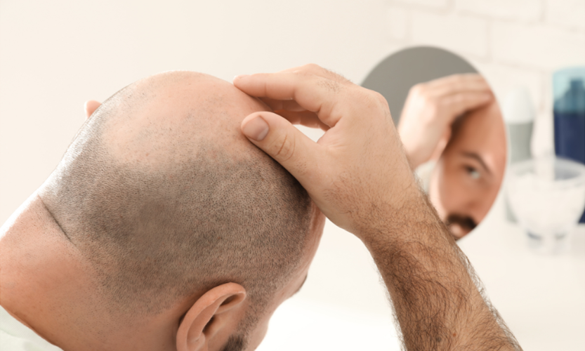 Pattern Baldness and role of PRP