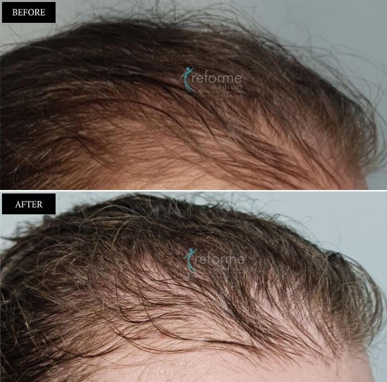 PRP- Hair Growth Treatment