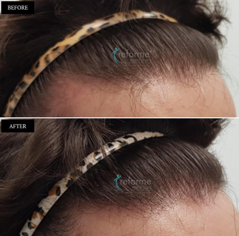 PRP- Hair Growth Treatment