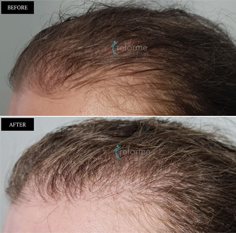 PRP- Hair Growth Treatment