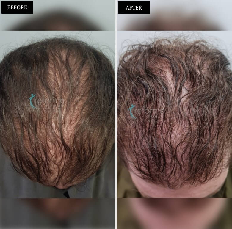 PRP- Hair Growth Treatment