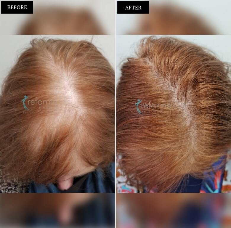 PRP- Hair Growth Treatment