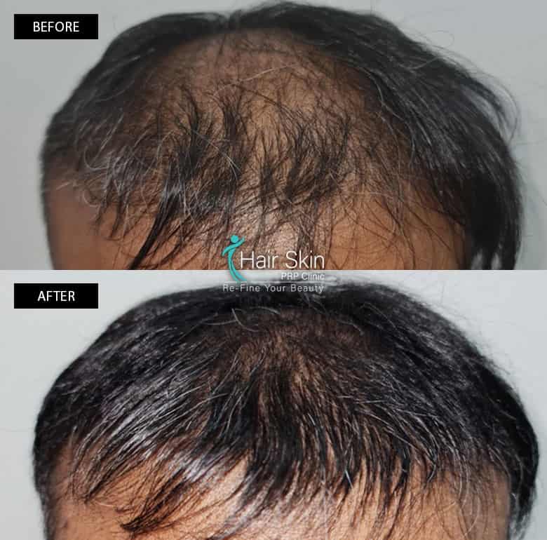 PRP-Hair Growth Treatment