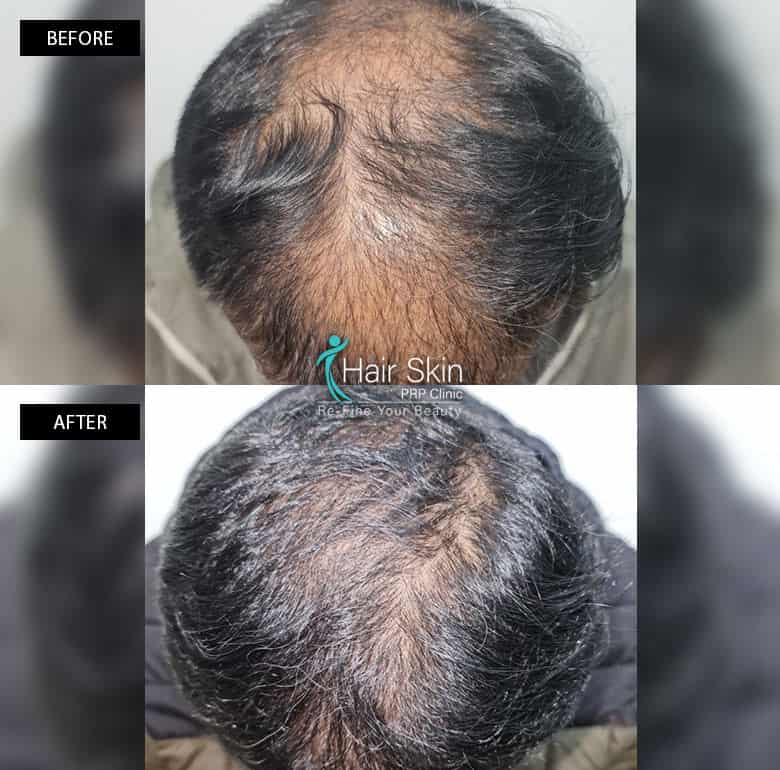 PRP-Hair Growth Treatment