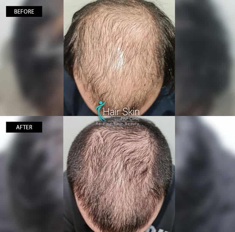 PRP-Hair Growth Treatment