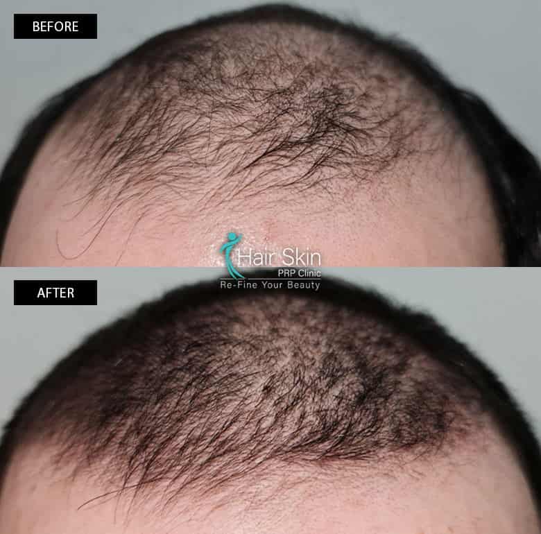PRP-Hair Growth Treatment
