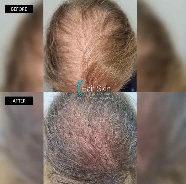 Prp- Hair Growth Program
