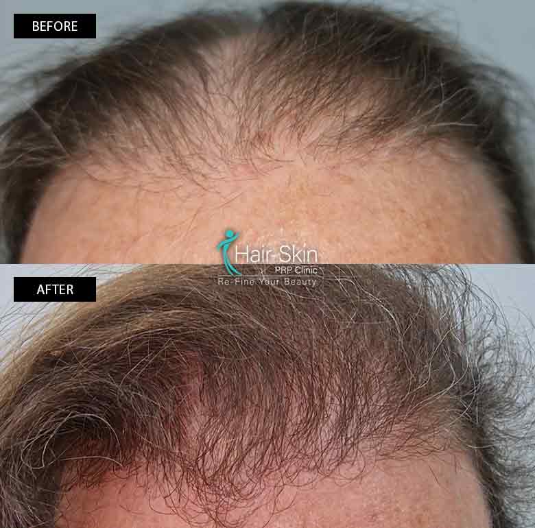 Prp- Hair Growth Program