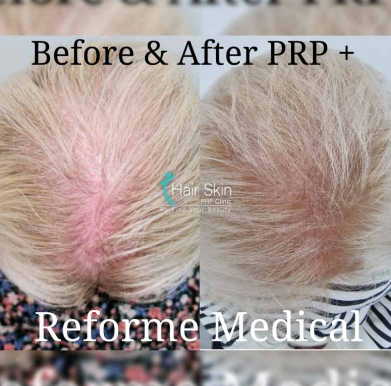 Prp- Hair Growth Program