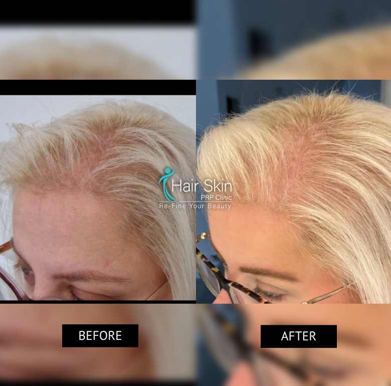 Prp- Hair Growth Program