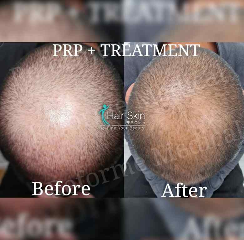 Prp- Hair Growth Program