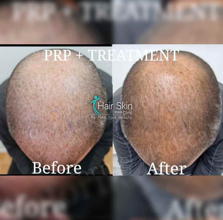 Prp- Hair Growth Program